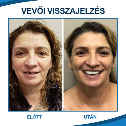 ORALHOE Fogmódosító fogsor fogszabályozó