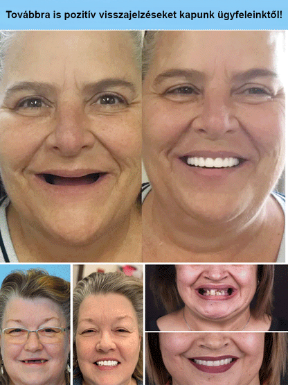 Szilikon Műfogsor Készlet