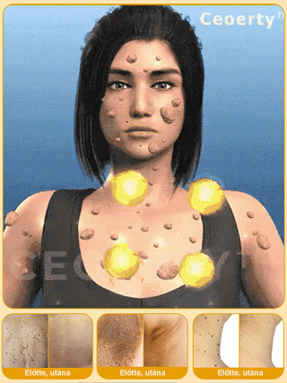 Testápoló szemölcs eltávolító megoldás