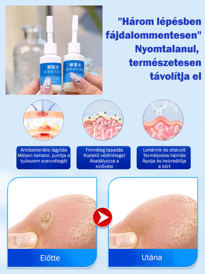 Tyúkszem eltávolító folyadék