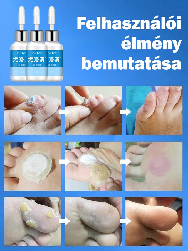 Tyúkszem eltávolító folyadék