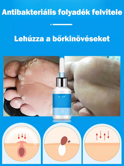 Tyúkszem eltávolító folyadék